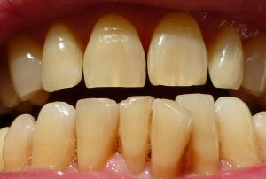 phương pháp tẩy trắng răng hiệu quả nhất