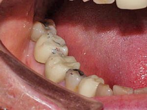 Nguyên nhân răng bị vàng ố