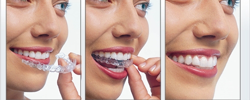 niềng răng tháo lắp có hiệu quả không?