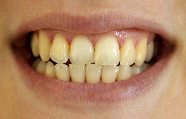 Ảnh hưởng của vết dính trên răng