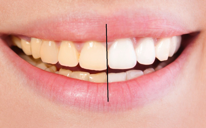 5 cách làm trắng răng hiệu quả tại nhà