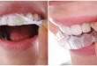 Phương pháp làm trắng răng giúp loại bỏ sạch mọi mảng bám