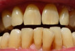 3 Cách làm trắng răng khi răng bị vàng bạn nên tìm hiểu