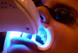 Tẩy trắng răng Laser Whitening cho hàm răng thay đổi hoàn toàn