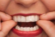 Kem tẩy trắng răng tại nhà và những điều bạn cần quan tâm