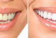Làm trắng răng xỉn màu biện pháp siêu hiệu quả tại nha khoa