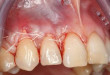 Làm răng trắng tại nhà bằng miếng dán có tác hại gì không?
