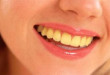Tại sao răng có màu vàng và cách khắc phục hiệu quả