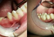 Bọc răng hàm bằng sứ cho hiệu quả ăn nhai tốt