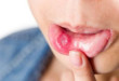 Lở miệng thiếu vitamin gì và bổ sung như thế nào?