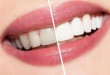 Làm trắng răng bằng laser bao nhiêu tiền? Chi phí tẩy trắng răng