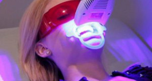 Tẩy trắng răng bằng tia laser – Tính năng vượt trội, tại sao bạn cần thử?