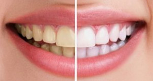 GIẢI ĐÁP THẮC MẮC: Tẩy trắng răng có hại không?
