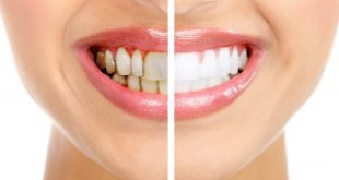 Có nên tẩy trắng răng không? câu hỏi này được nhiều bạn quan tâm