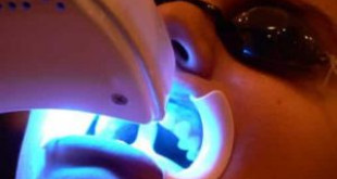 Tẩy trắng răng Laser Whitening cho hàm răng thay đổi hoàn toàn