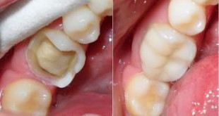 Quy trình trám răng sâu như thế nào? XEM TẠI ĐÂY