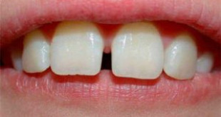Trám răng thưa hiệu quả nhất năm 2017 Răng khít đẹp