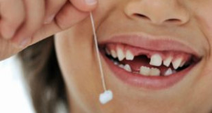 Răng sữa bị sâu có nên nhổ hay không?