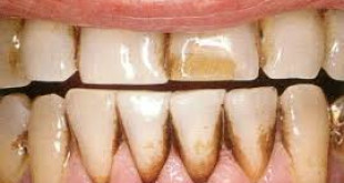 Vết dính trong răng