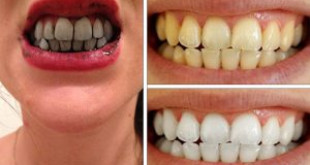 Có nên làm trắng răng bằng than hoạt tính? Thực hư hiệu quả của phương pháp này
