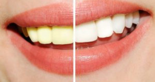 Làm trắng răng giá cả bao nhiêu? – Chi phí tẩy trắng bằng công nghệ mới