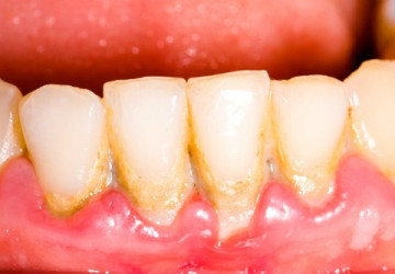 Răng bong tróc – Nguyên nhân và cách điều trị