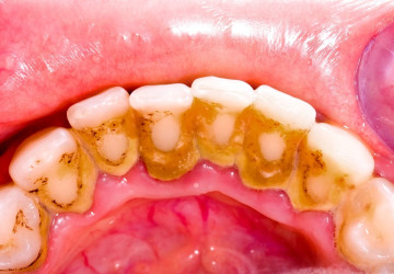 Những nguy hiểm của vôi răng gây ra