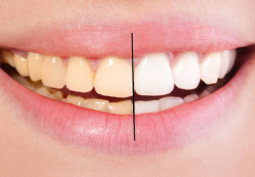 5 cách làm trắng răng hiệu quả tại nhà Vĩnh Viễn sau 1 lần