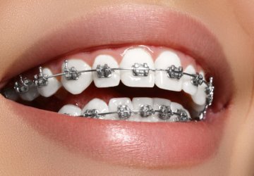 Bật mí ưu nhược điểm của niềng răng mắc cài là gì?